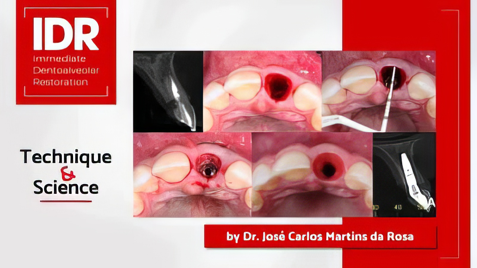 Pikos Institute Immediate Dentoalveolar Restoration