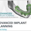Advanced Implant Planning Course (Full Arch with Blue Sky and Meshmixer)
