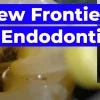 OHI-S New Frontiers in Endodontics Guide to Predictable Practice
