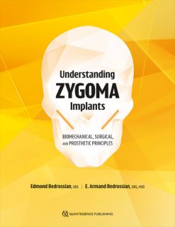 Understanding Zygoma Implants: Biomechanical, Surgical, and Prosthetic Principles