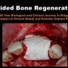 Guided Bone Regeneration A 30 year Biological and Clinical Journey in Ridge Augmentation