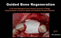 Guided Bone Regeneration A 30 year Biological and Clinical Journey in Ridge Augmentation