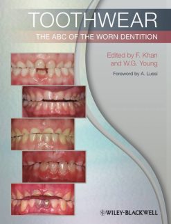 Toothwear: The ABC of the Worn Dentition