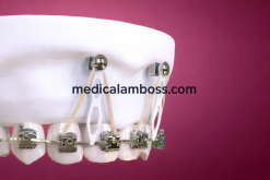 OHI-S Microimplant Anchorage in Clinical Practice Guide for Beginners and Intermediate