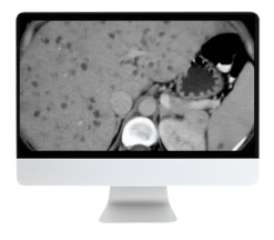 ARRS State of the Art Liver Imaging in Cirrhosis 2021 ( VIDEOS)