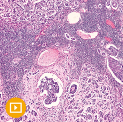 Breast Pathology 2023 (CME VIDEOS)