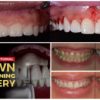 Esthetic and Functional Crown Lengthening Course