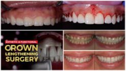 Esthetic and Functional Crown Lengthening Course