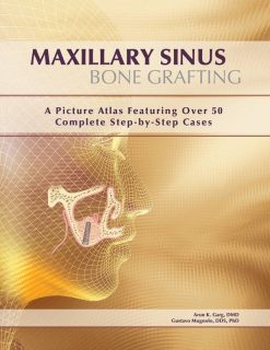 Maxillary Sinus Bone Grafting: A Picture Atlas Featuring over 50 Complete Step-By-Step Cases