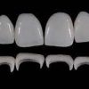 Gidedental Prosthetic Rehabilitation on Natural Teeth – Predictable, Esthetic and Systematic Steps 2020