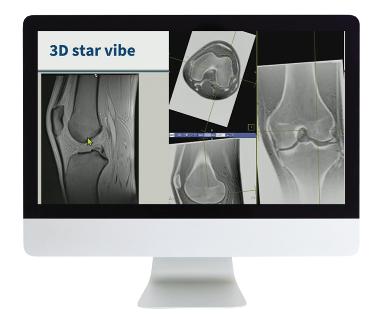 American Roentgen Ray Society 3D MR Imaging of Joints with Arthroscopy Correlations 2023