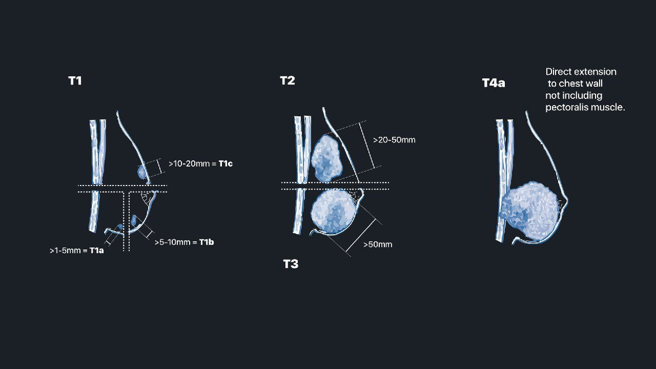 MRIOnline Mastery Series: Evaluation of Newly Diagnosed, Pre-Operative Breast Cancer Patients 2021