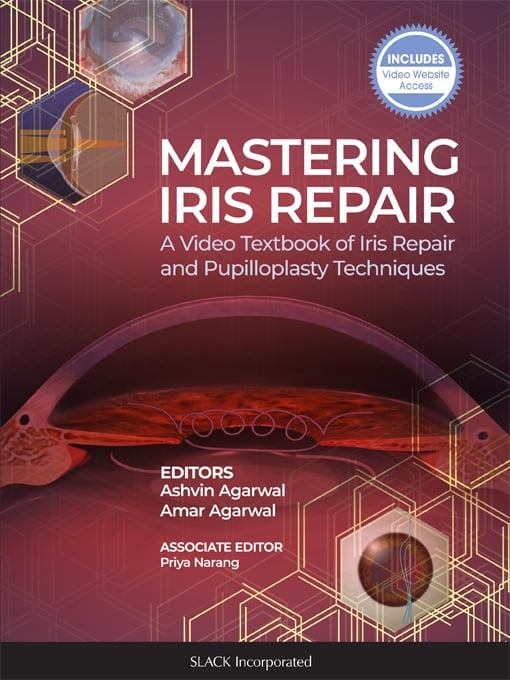 Mastering Iris Repair: A Video Textbook of Iris Repair and Pupilloplasty Techniques (PDF Book)