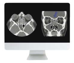 ARRS Cranial Nerve Imaging: From the Least to the Last 2022 ( Videos + CME Questions)