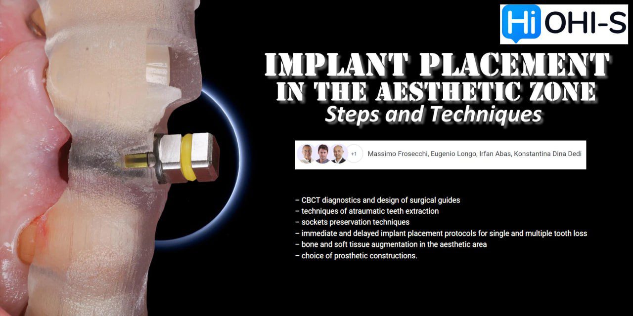 OHI-S Implant Placement in the Aesthetic Zone: Steps and Technique OHI-S Implant Placement in the Aesthetic Zone: Steps and Technique